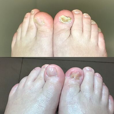 Kogemus Iisraelist pärit promicil -kreemi barnabade kasutamisel, foto enne ja pärast