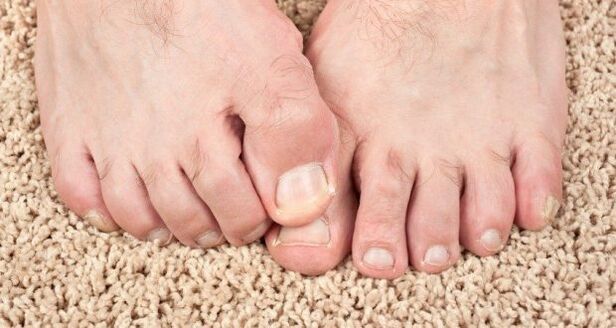 Küünte seene sümptomid