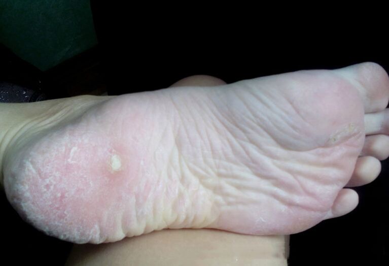 Seene töötlemine laseriga