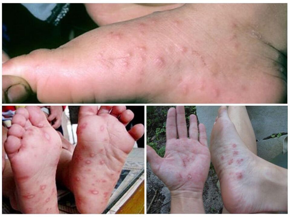 Hüperkeratootilised kahjustused jalgadel