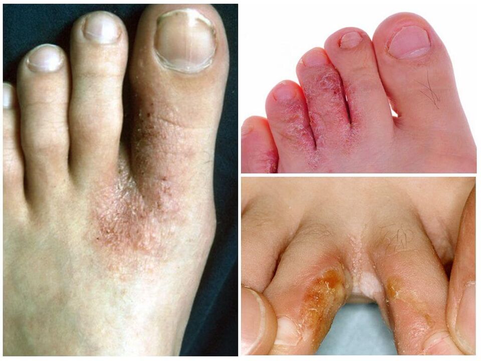 Interdigitaalne mükoos