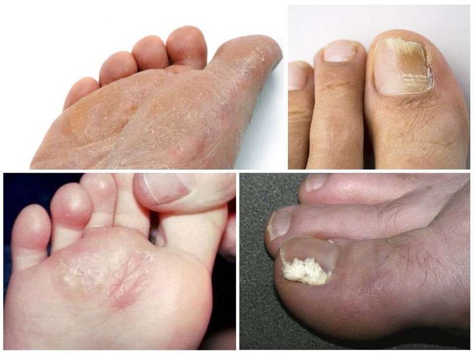 Jalaseene esialgne staadium