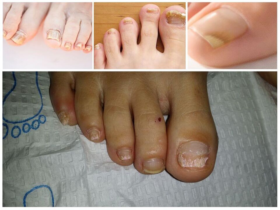 Küünteplaatide seenhaigused