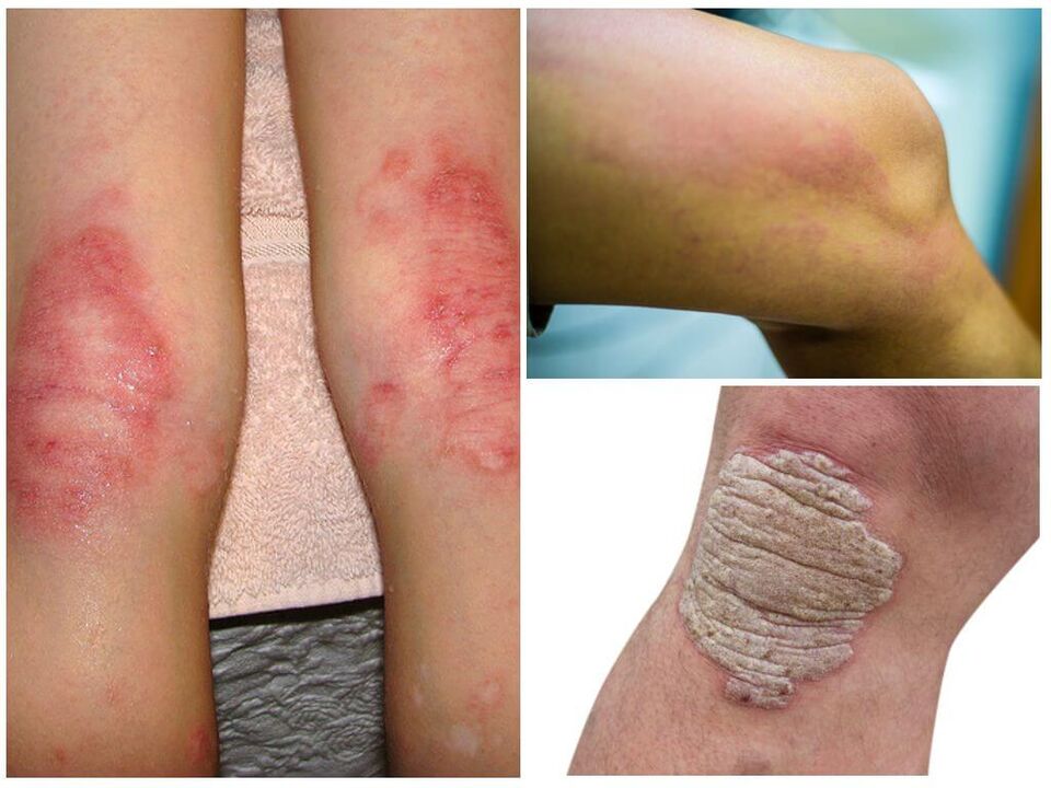 Põlvede seeninfektsioonid