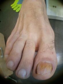 suure varba küünte seen