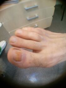 suure varba küünte seenhaiguse algstaadium