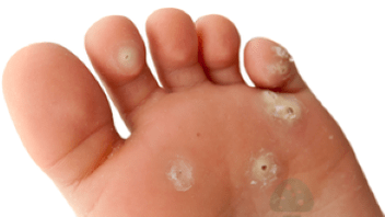 seeninfektsiooni teine ​​etapp